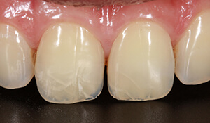 Can a cracked tooth be repaired