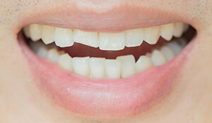 Smiling person with a chipped tooth